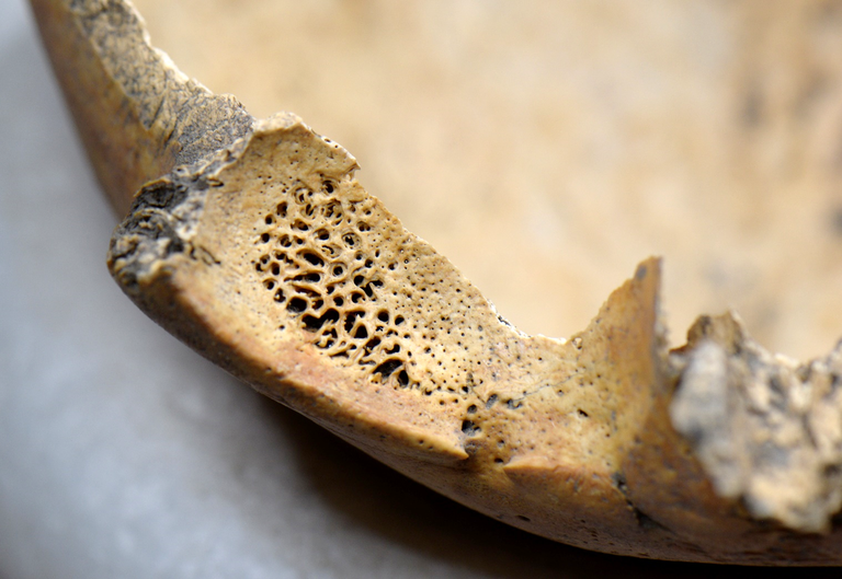 Close up of a skull fragment with cribra orbitalia (tiny holes)
